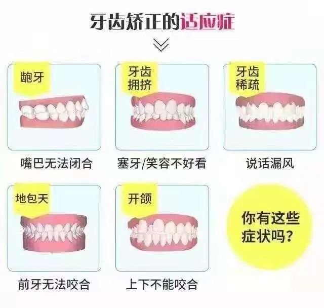 牙齿贴面针对形态异常牙,黑牙黄牙,氟斑牙,四环素牙,色素牙,牙缝隙大